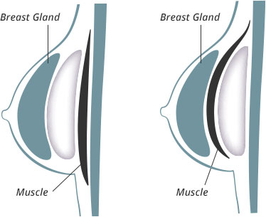 Breast Augmentation Fayetteville Wilmington Raleigh NC
