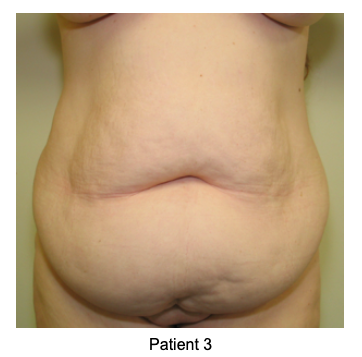 Tummy Tuck vs Liposuction - NuBody Concepts