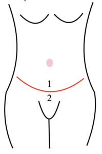 Graphic of front view of belly button where it is inset into the flap during the tummy tuck procedure